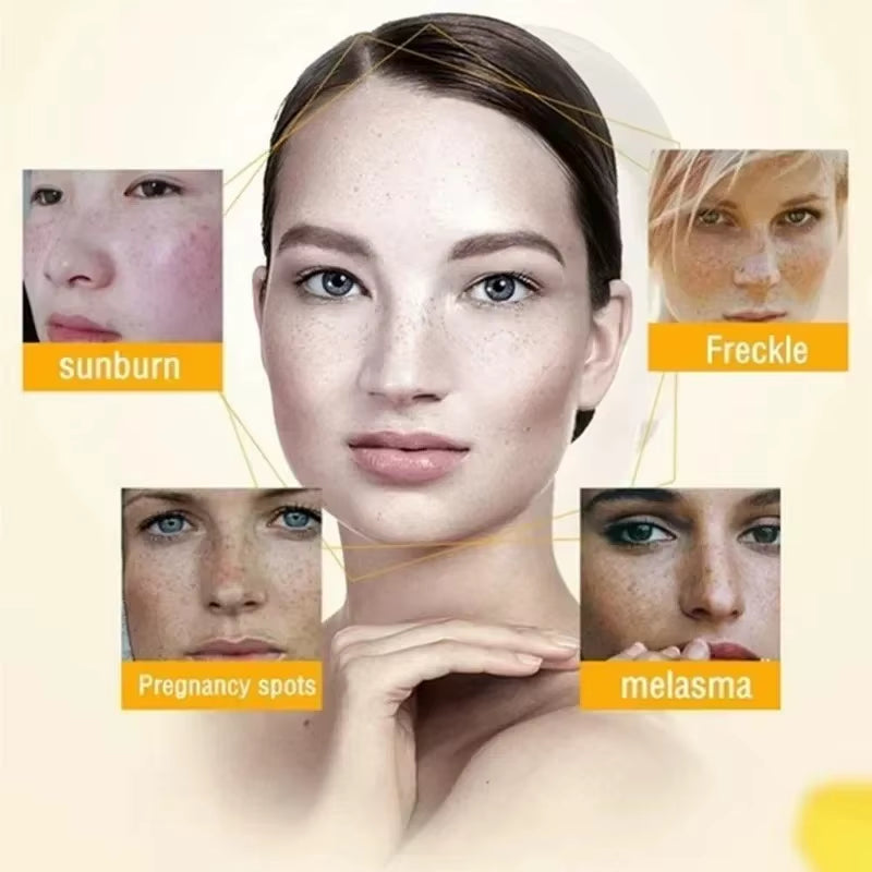 Whitening Freckle Cream Remove Dark Spots anti Freckle Face Creams Niacinamide Fade Pigmentation Melasma Brighten Skin Care 20G