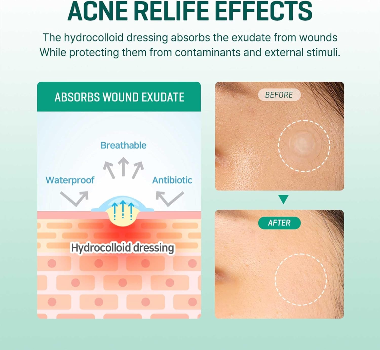 Some By Mi 30 Days Miracle Clear Spot Patch - Pack of 1, 18 Counts