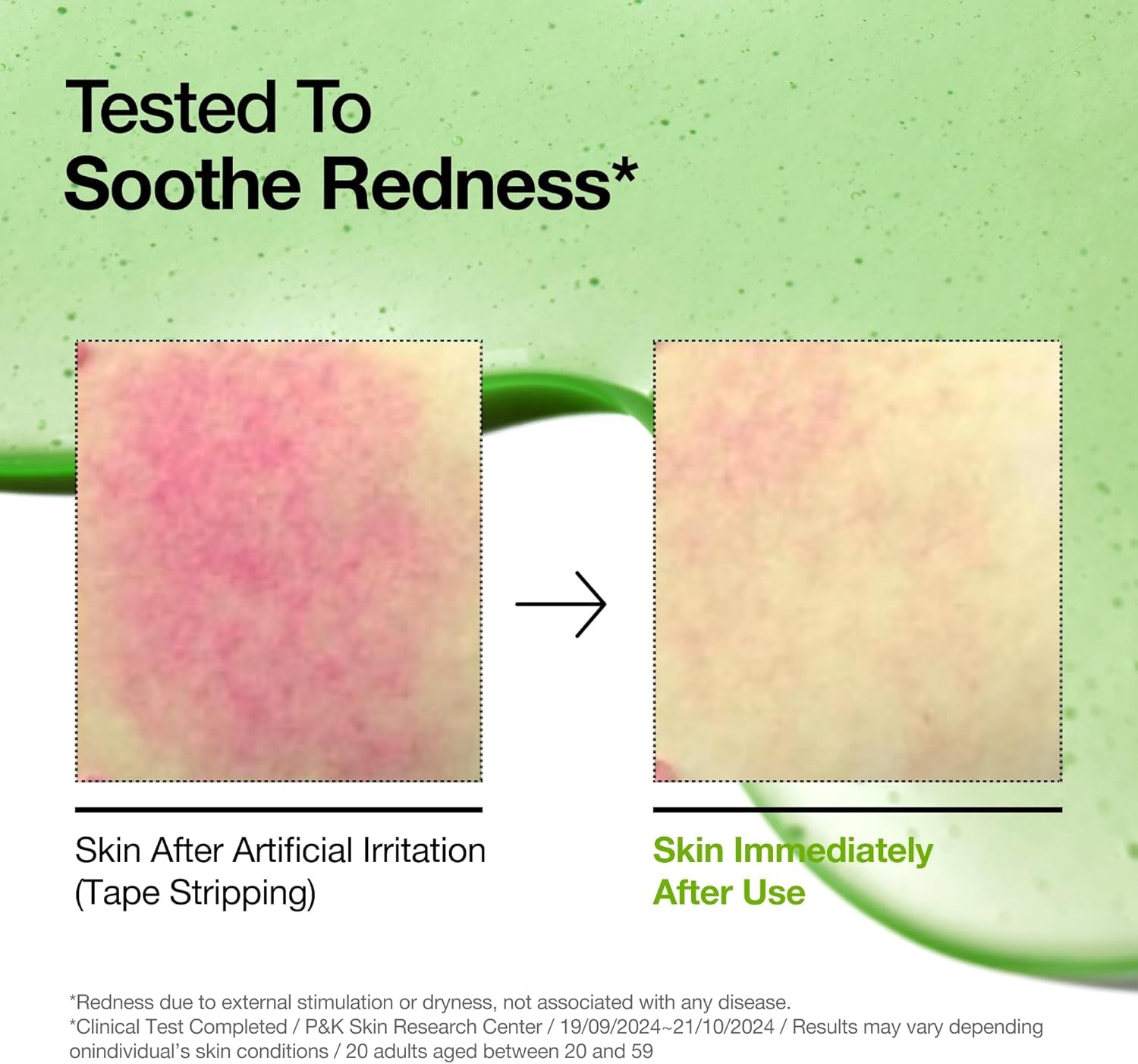 Azelaic Acid 10% & Hyaluronic Acid Redness Soothing Serum for Sensitive Skin - Vegan Korean Skincare (30ml)