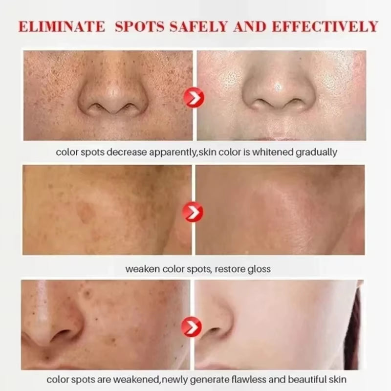 Whitening Freckle Cream Remove Dark Spots anti Freckle Face Creams Niacinamide Fade Pigmentation Melasma Brighten Skin Care 20G